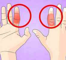 Hoe om `n gebroke vinger te behandel