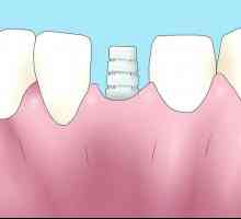 Hoe om tandheelkundige beenverlies te omkeer