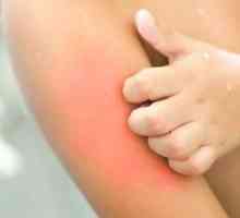 Hoe om atopiese dermatitis te behandel