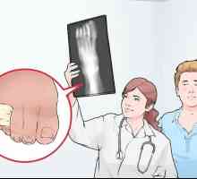 Hoe om `n klein vinger van die gebroke voet te verbind