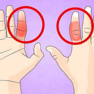 Hoe om `n gebroke vinger te behandel
