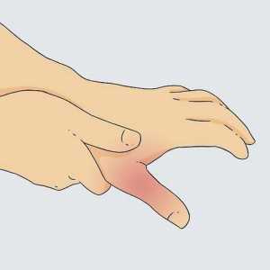 Hoe om `n gebroke duim te diagnoseer
