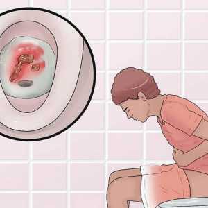 Hoe ulseratiewe kolitis kan onderskei van soortgelyke gesondheidsprobleme